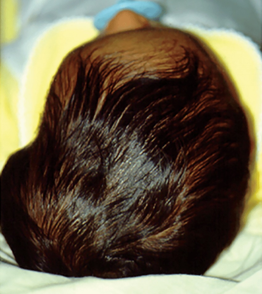 What Is A Cephalohematoma Nj Craniofacial Center