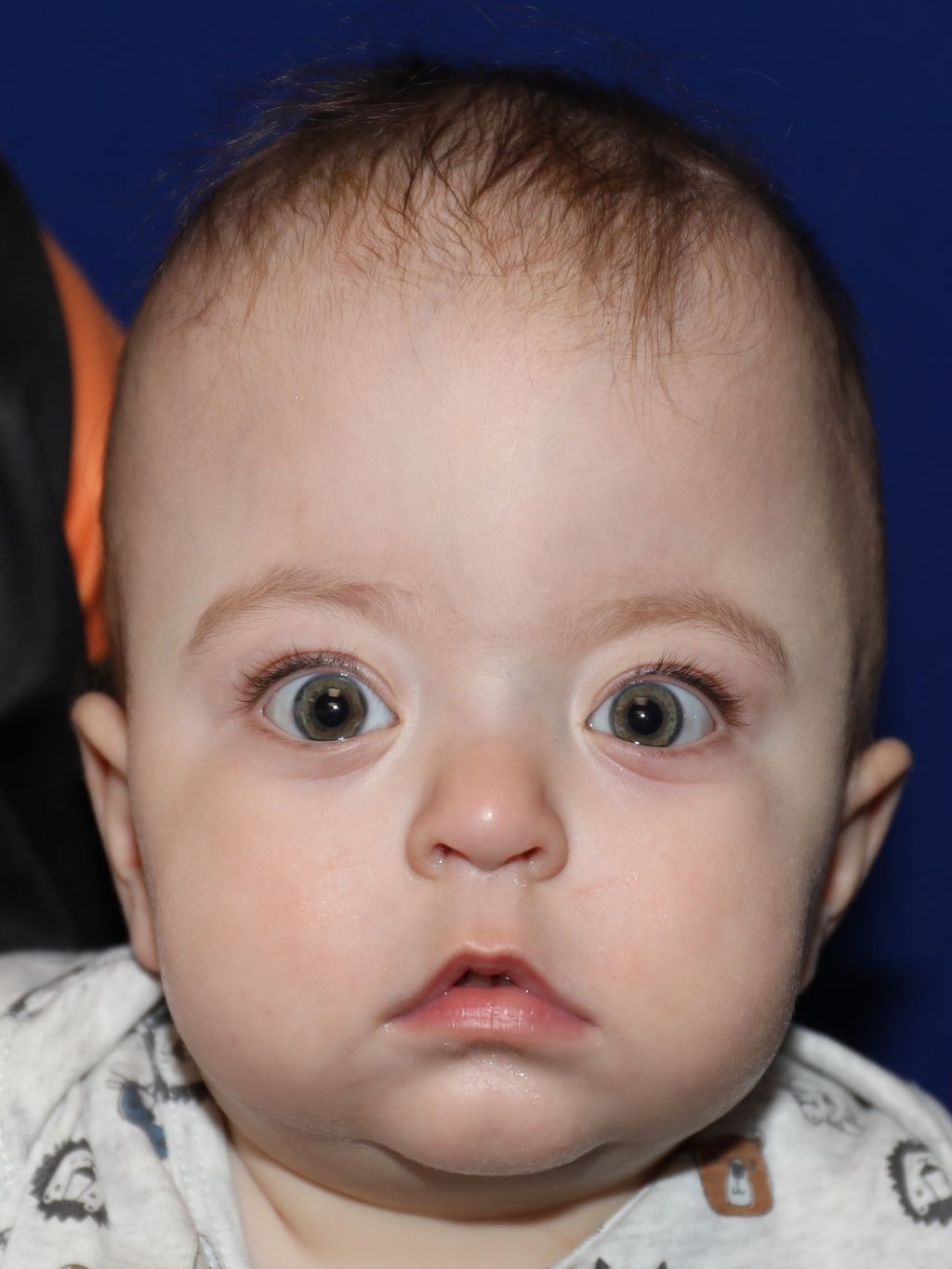 Before  treatment - Baby Emma
