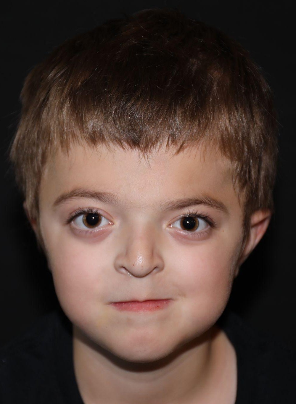 Front view at Year 4 after treatment - Case 1001