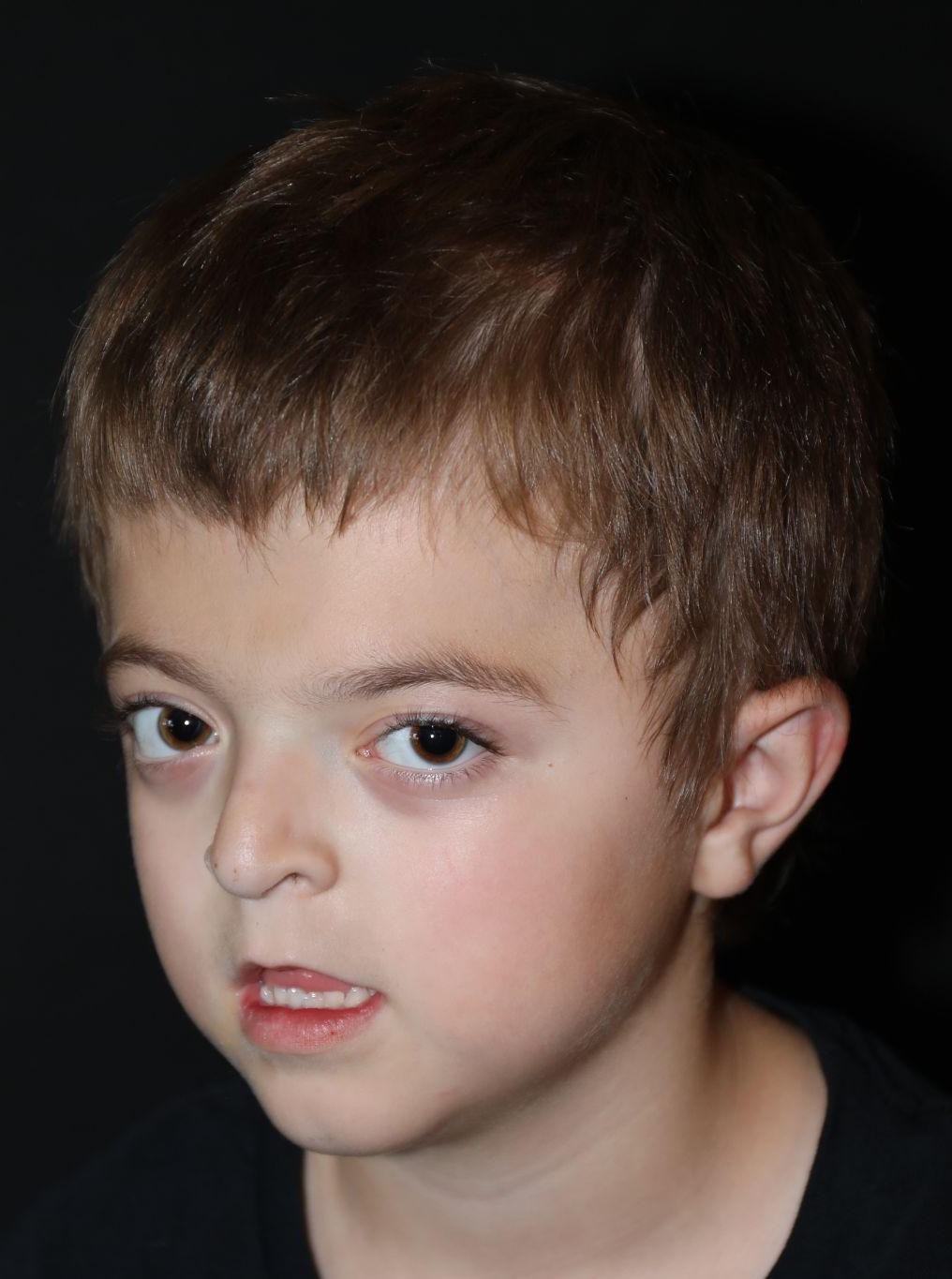 Left angle at Year 4 after treatment - Case 1001