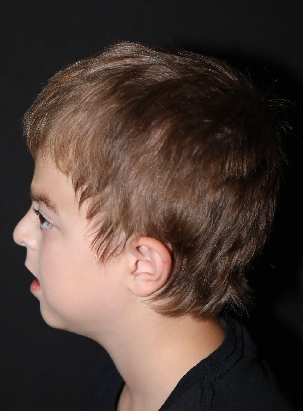 Left profile at Year 4 after treatment - Case 1001
