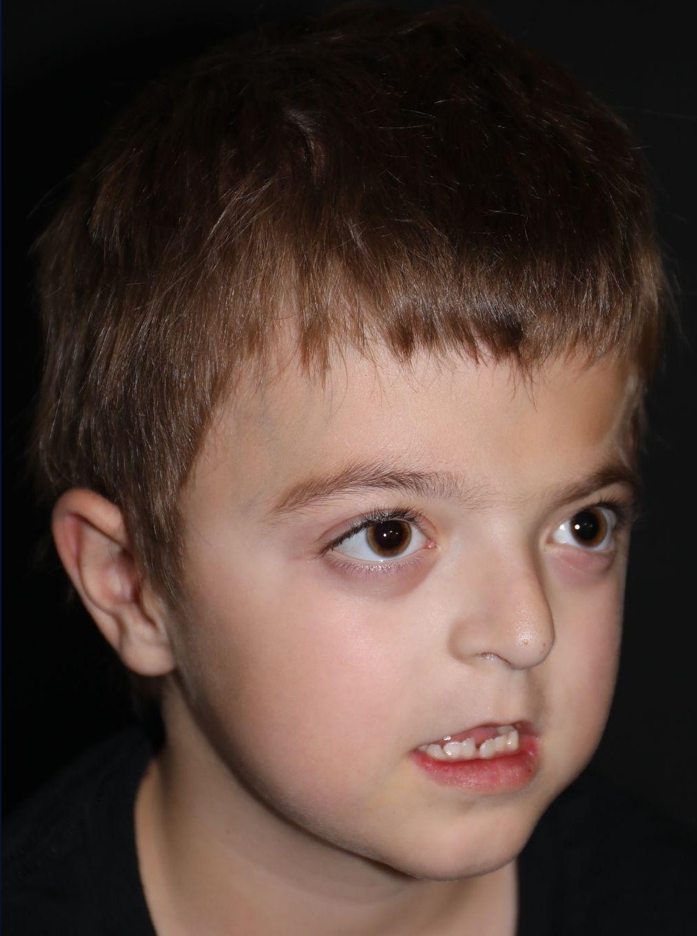 Right angle at Year 4 after treatment - Case 1001