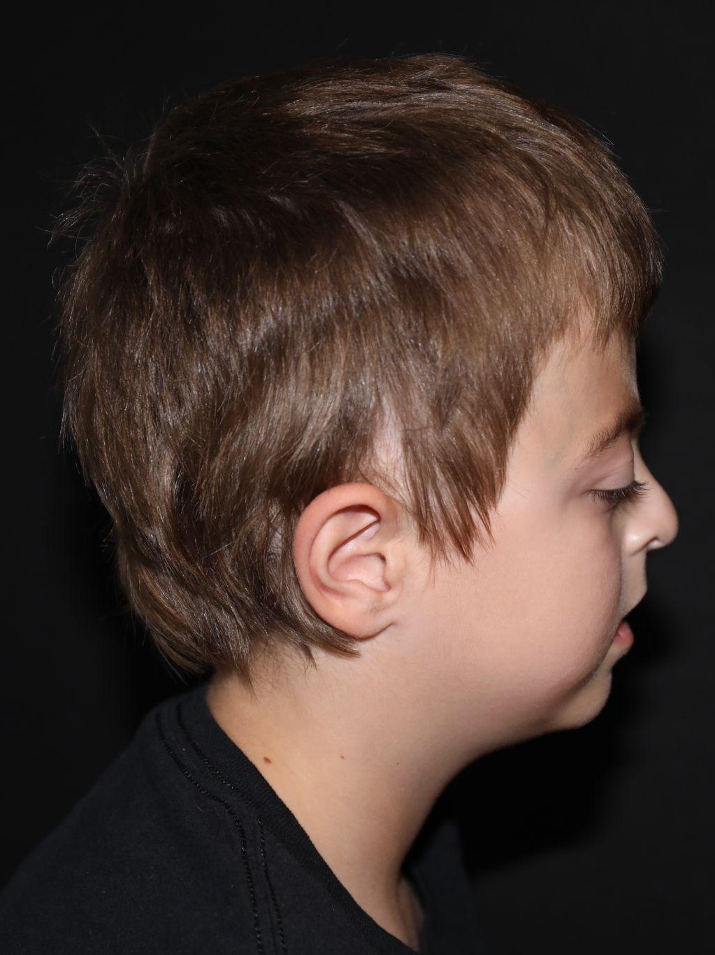 Right profile at Year 4 after treatment - Case 1001