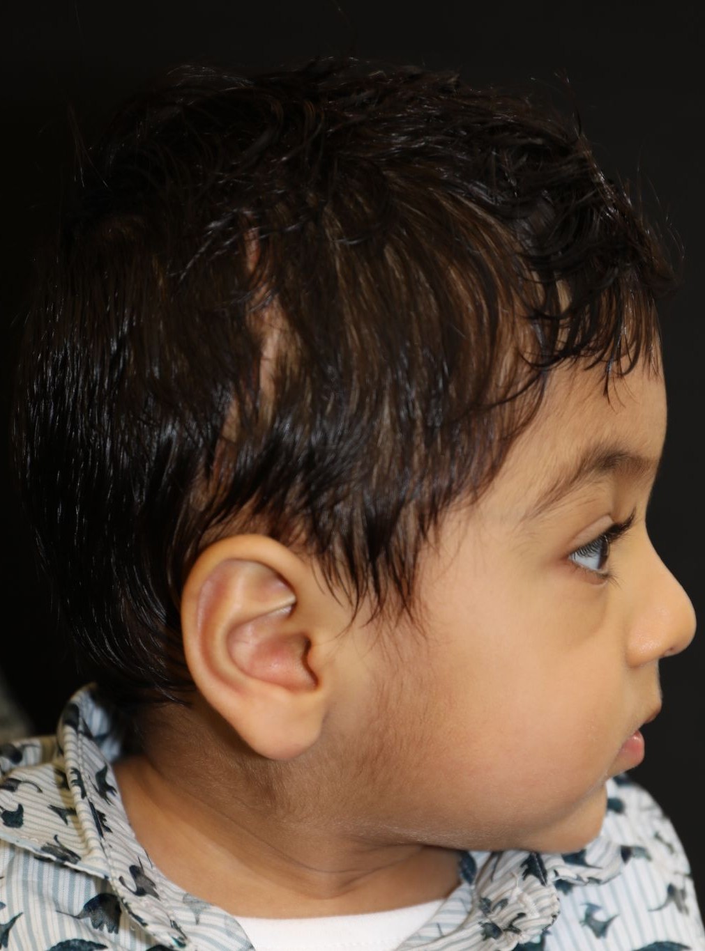 Right profile at Year 3 after treatment - Case 1009