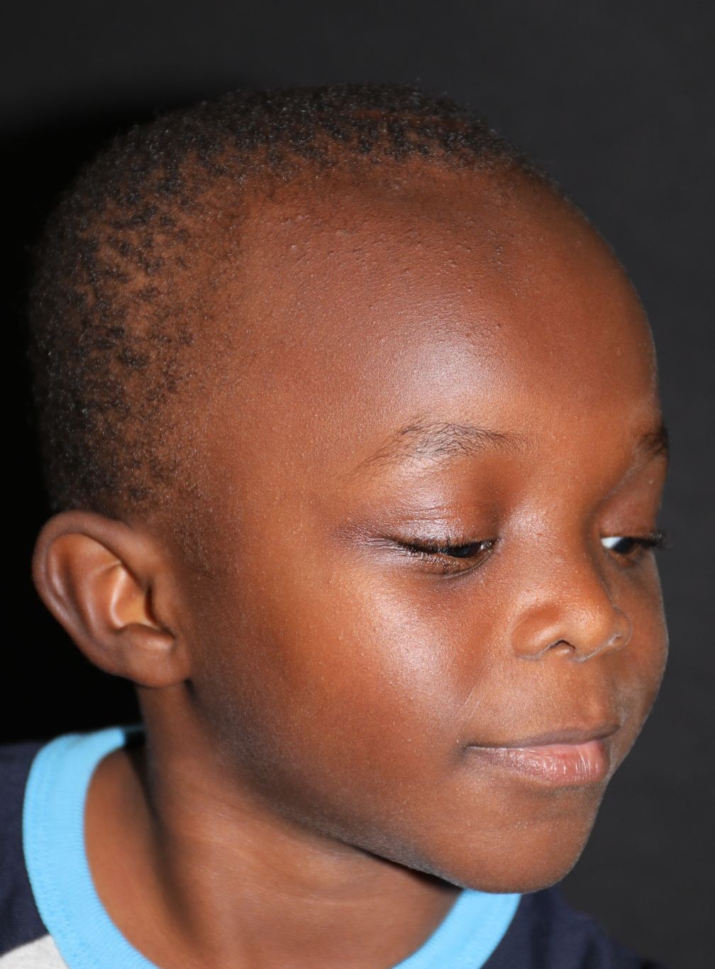 Right angle at Year 4 after treatment - Case 1005