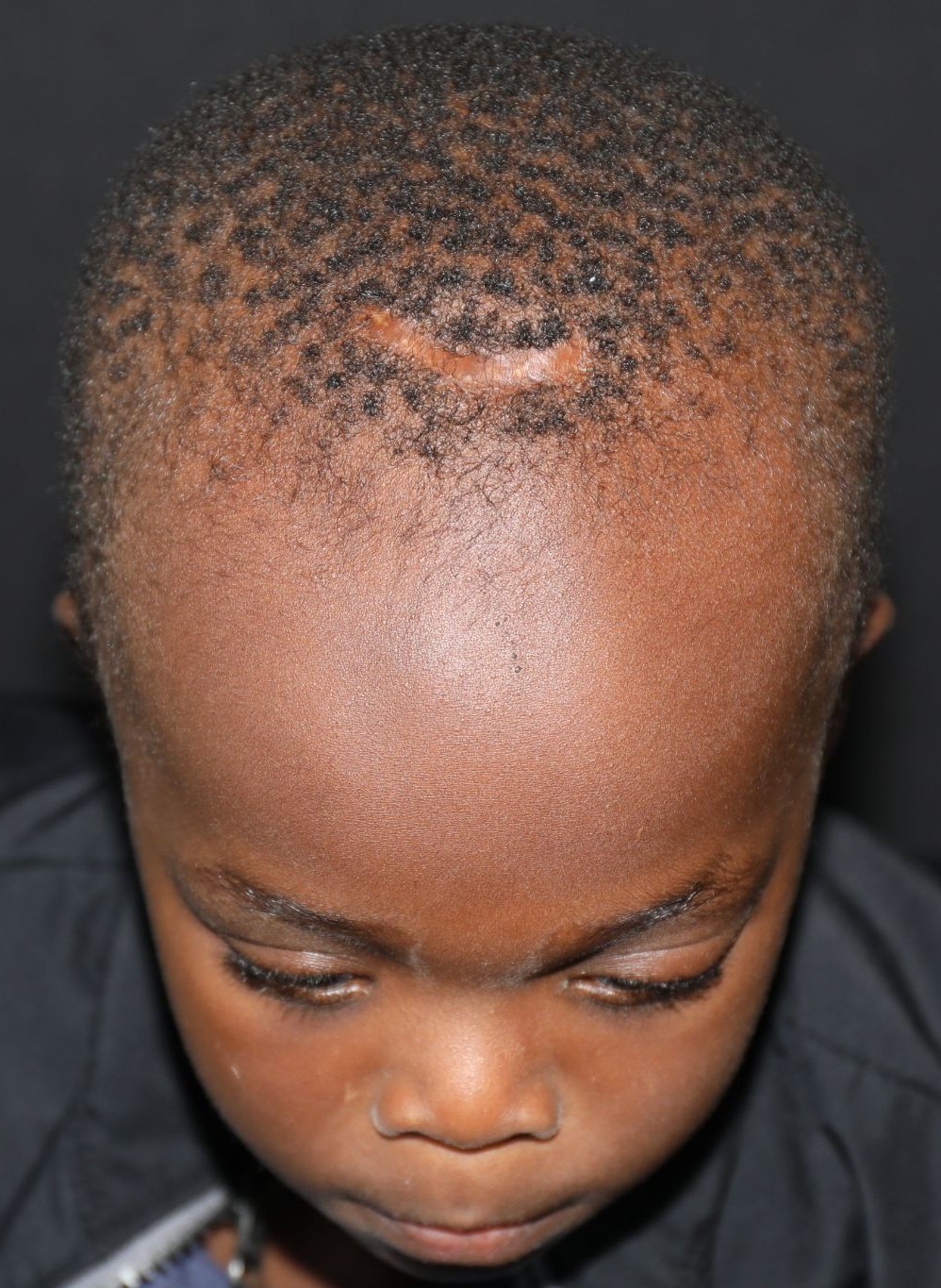 Top (vertex) at Year 3 after treatment - Case 1005