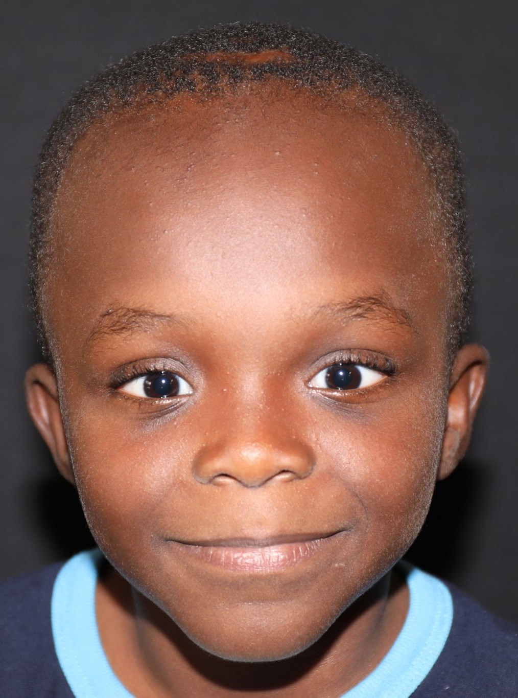 Front view at Year 4 after treatment - Case 1005