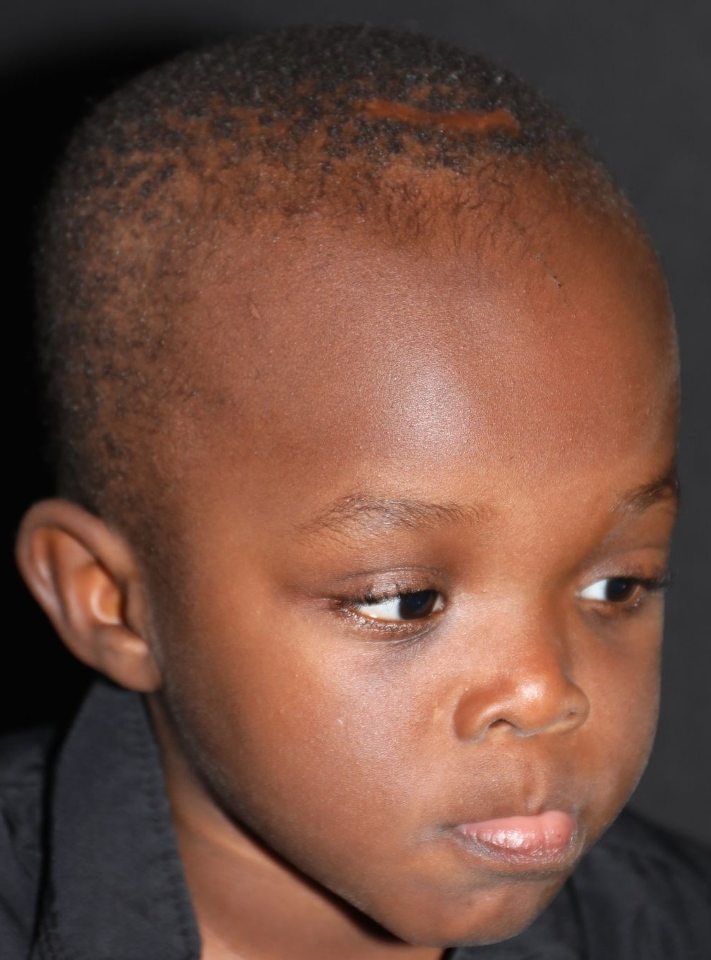 Right angle at Year 3 after treatment - Case 1005