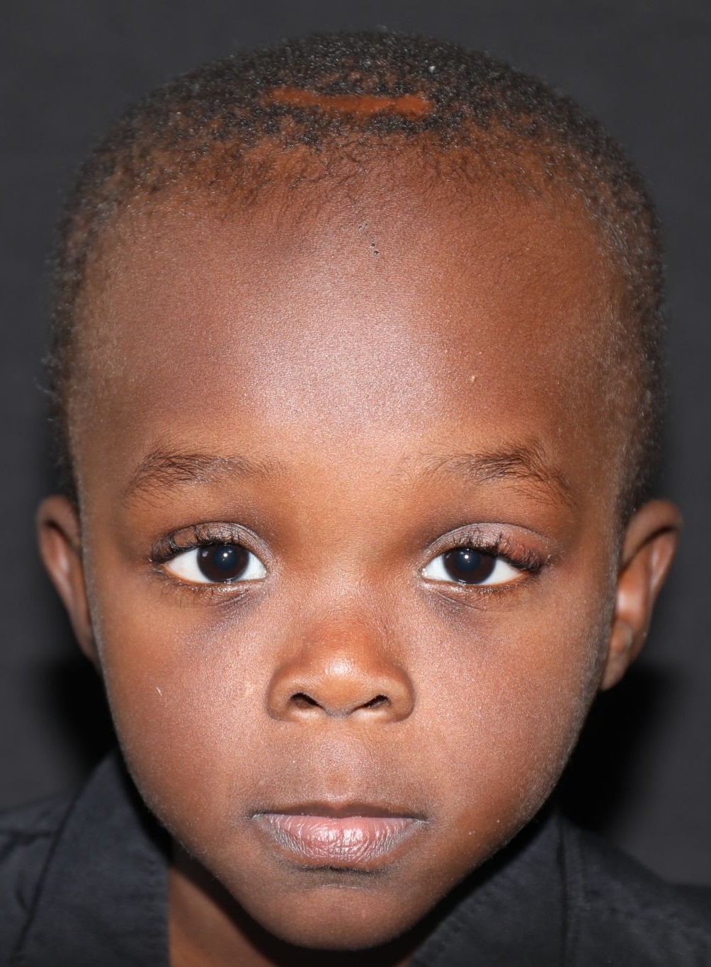 Front view at Year 3 after treatment - Case 1005