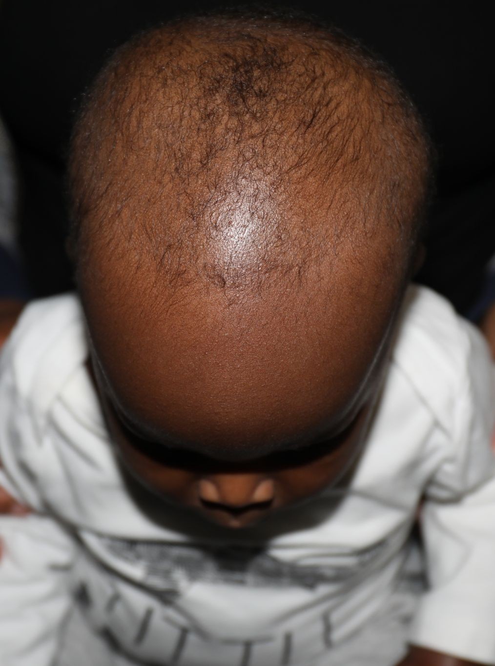 Top (vertex) before treatment - Case 1005