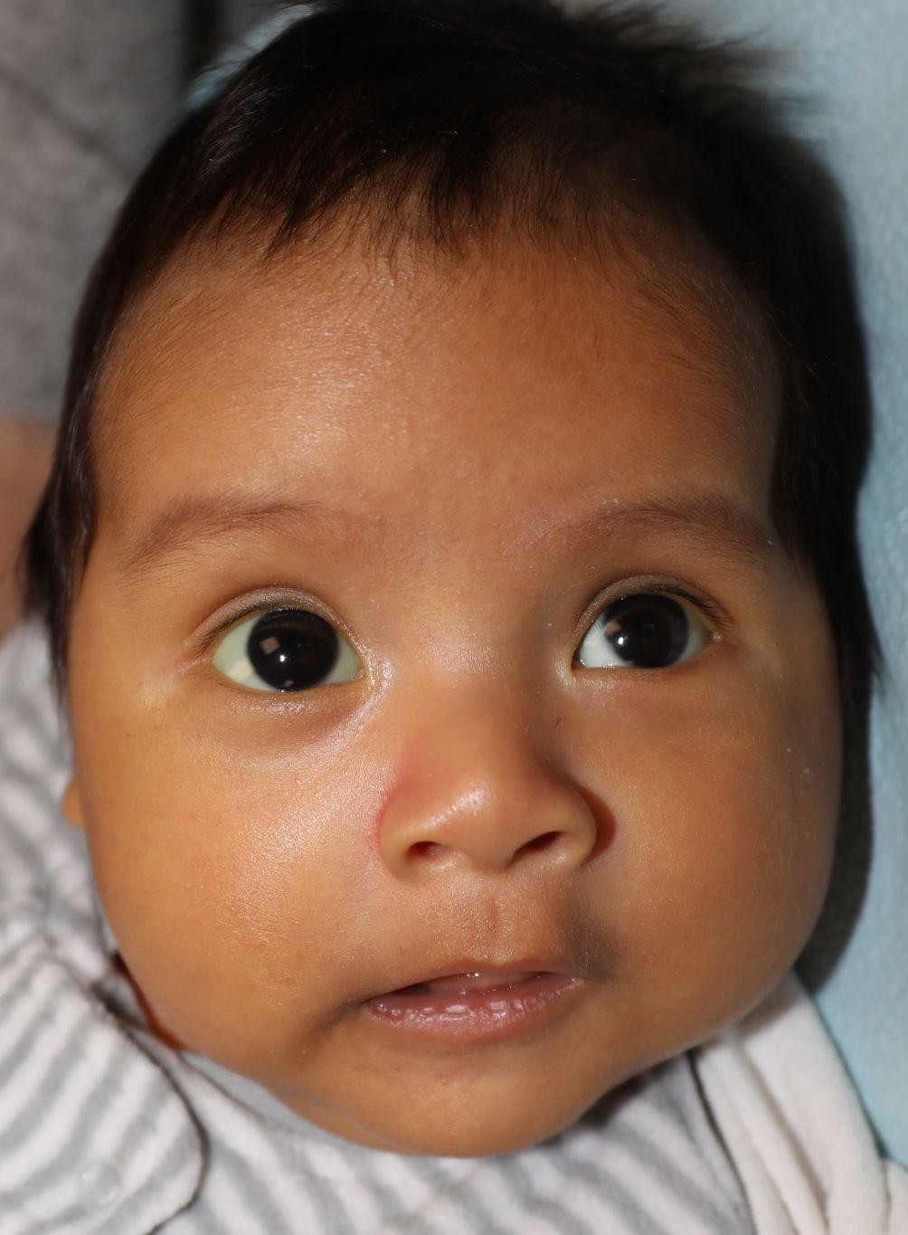 Front view before treatment - Case 1003