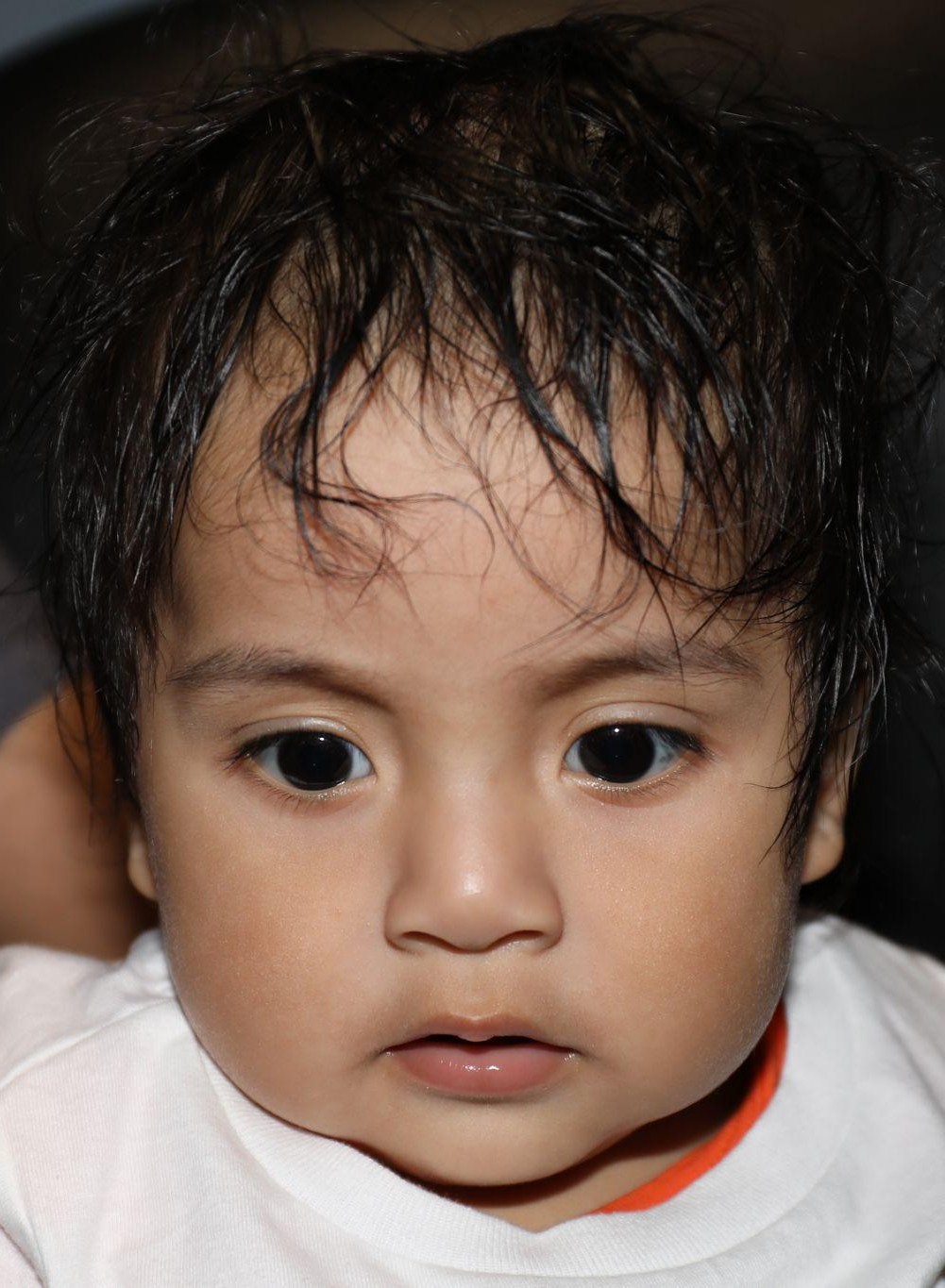 Front view at Year 2 after treatment - Case 1003