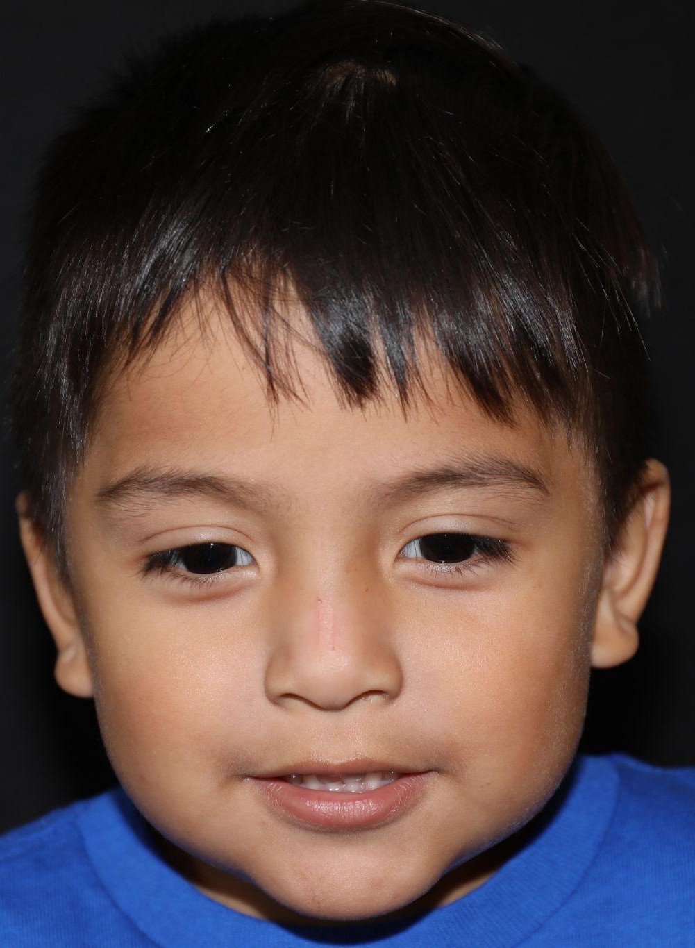 Front view at Year 3 after treatment - Case 1003