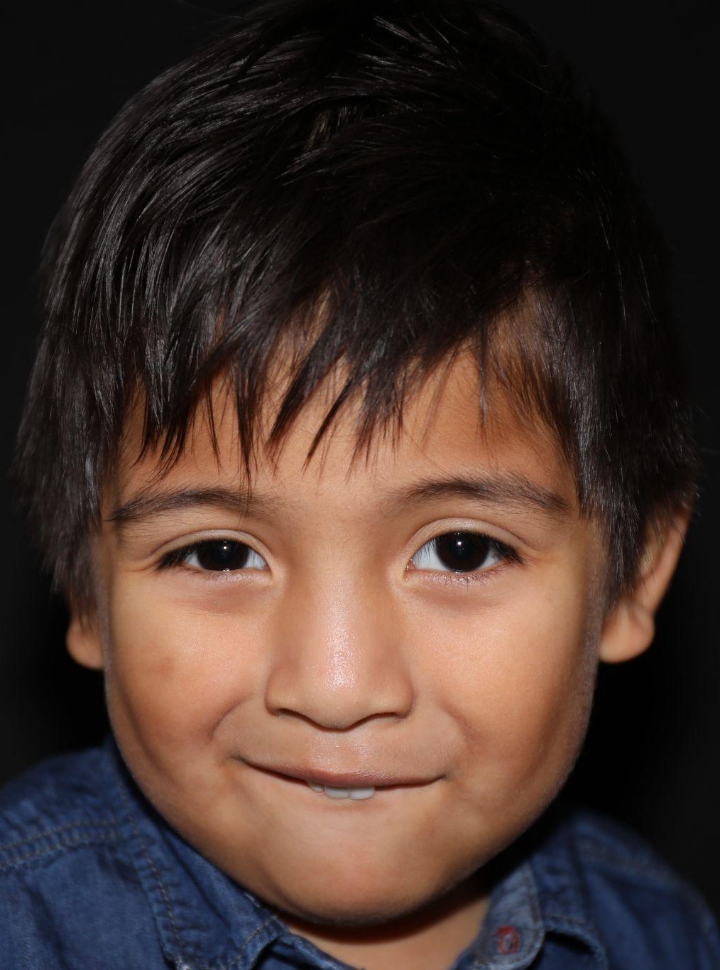 Front view at Year 4 after treatment - Case 1003