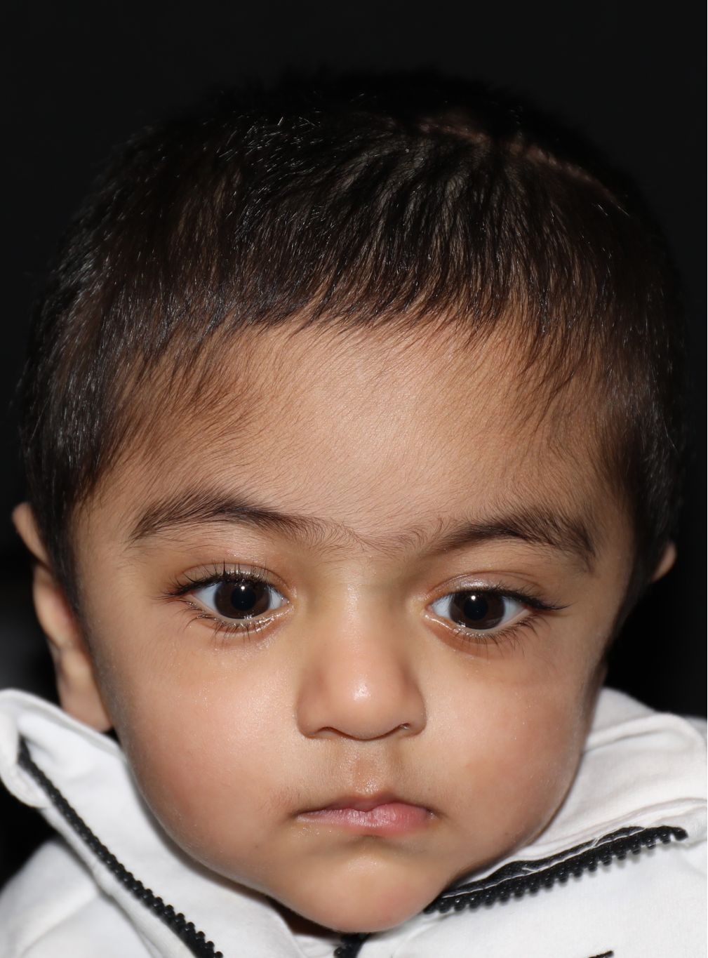Front view at Year 2 after treatment - Case 1009