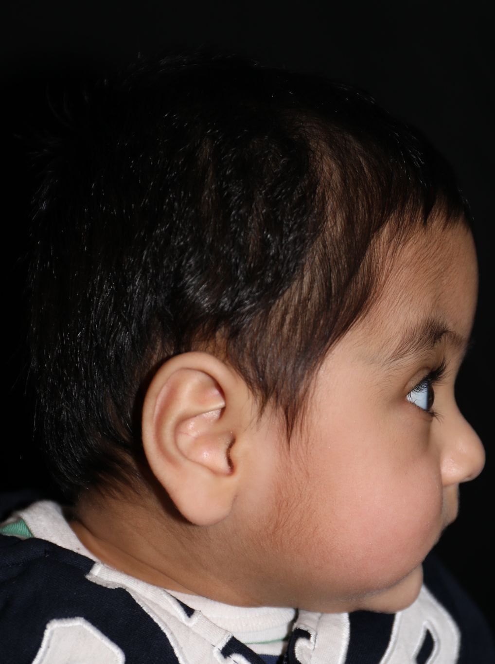 Right profile before treatment - Case 1009
