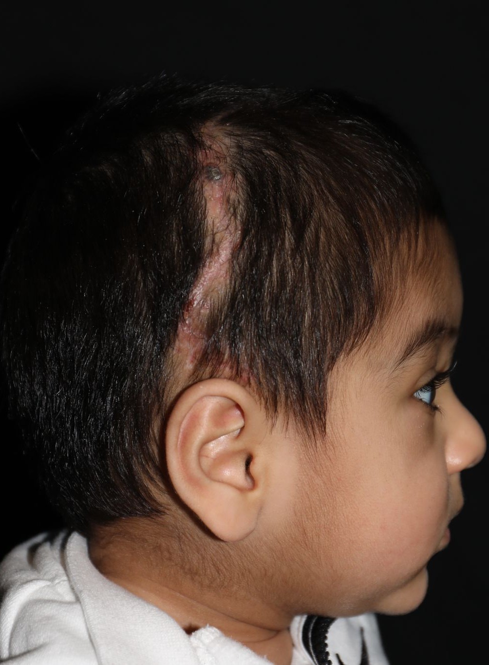 Right profile at Year 2 after treatment - Case 1009