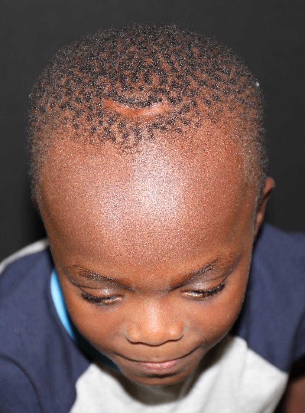 Top (vertex) at Year 4 after treatment - Case 1005
