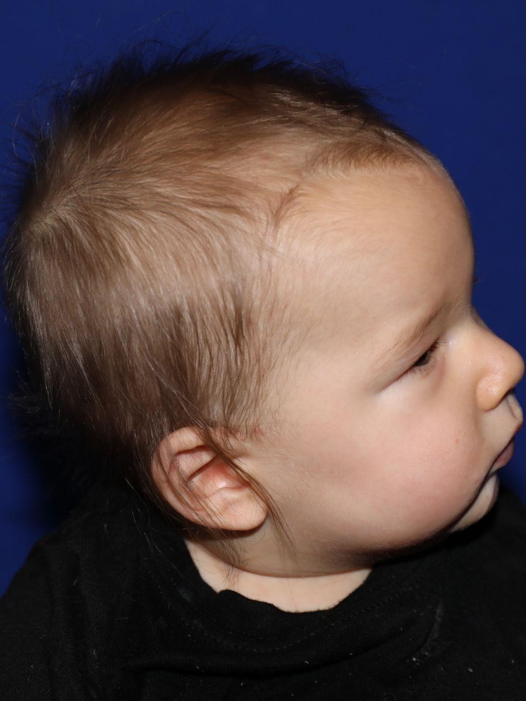 Right profile before treatment - Case 1002