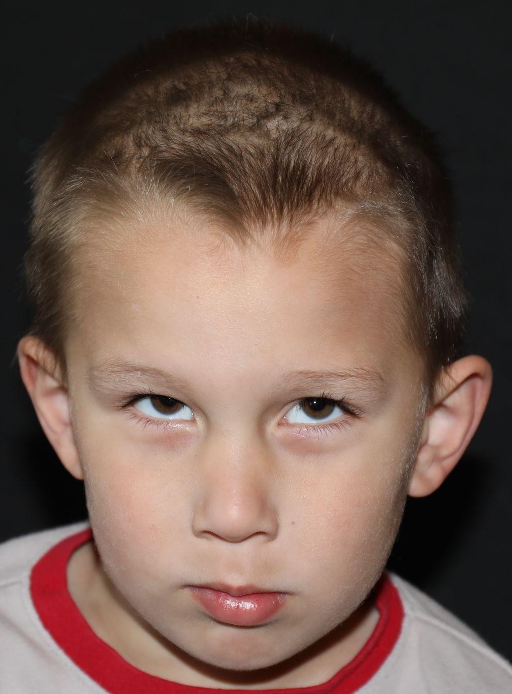 Front view at Year 3 after treatment - Case 1002