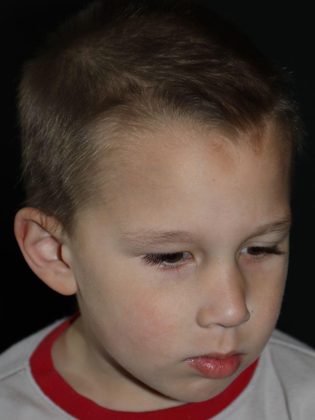 Right angle at Year 3 after treatment - Case 1002