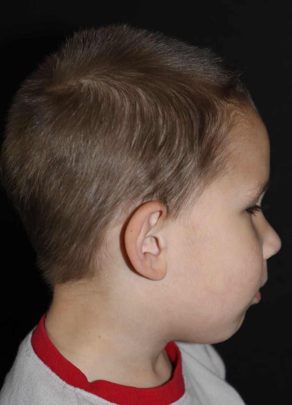 Right profile at Year 3 after treatment - Case 1002