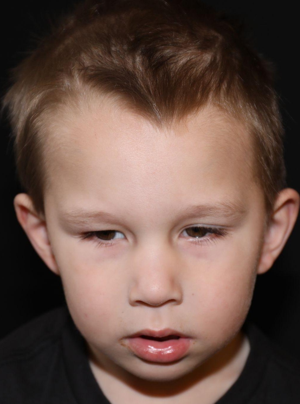 Front view at Year 2 after treatment - Case 1002