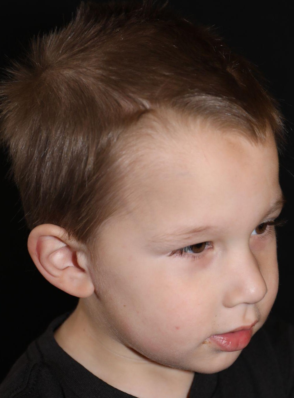 Right angle at Year 2 after treatment - Case 1002