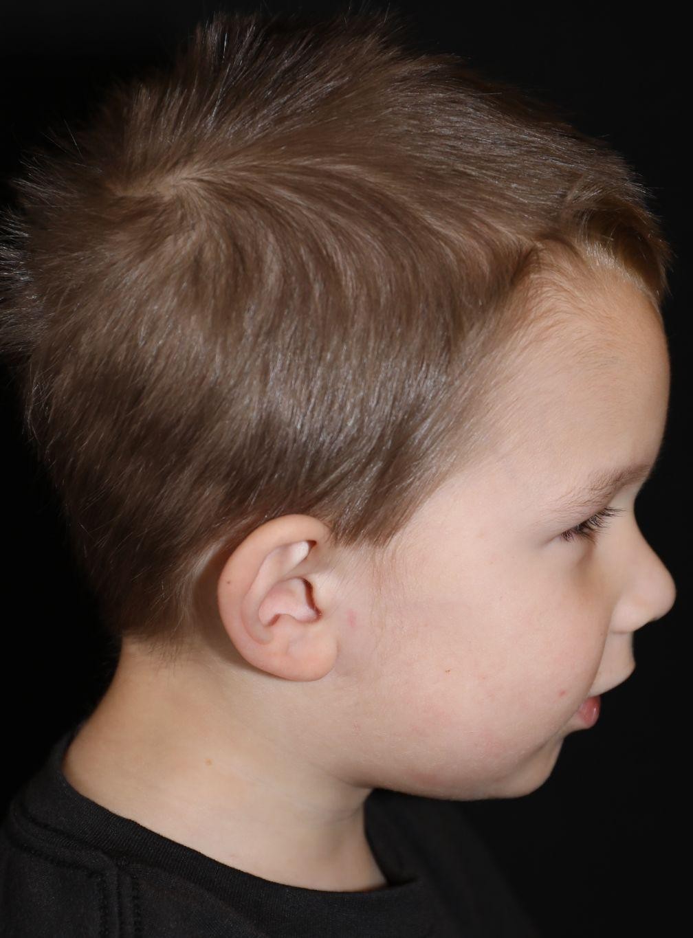 Right profile at Year 2 after treatment - Case 1002