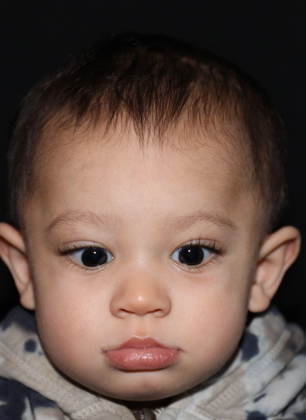 Front view at Year 2 after treatment - Case 1004