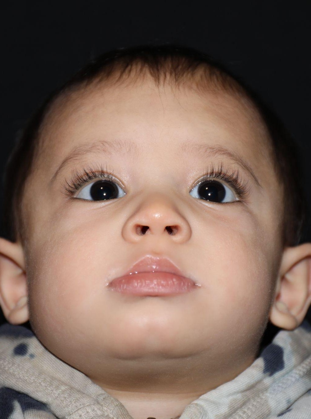 Chin at Year 2 after treatment - Case 1004