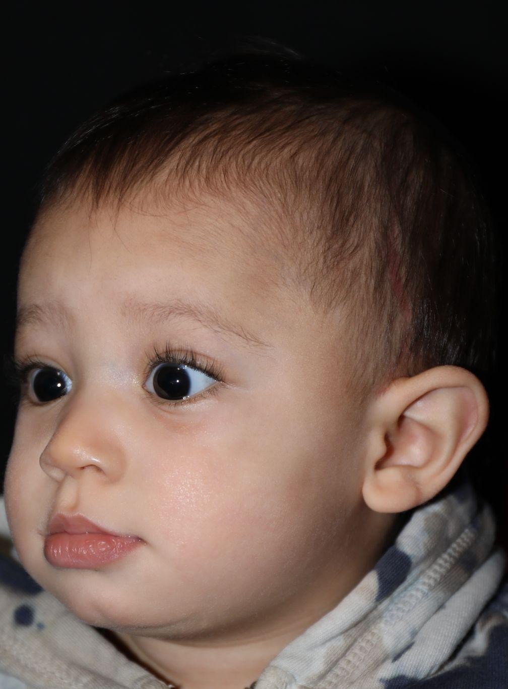 Left angle at Year 2 after treatment - Case 1004