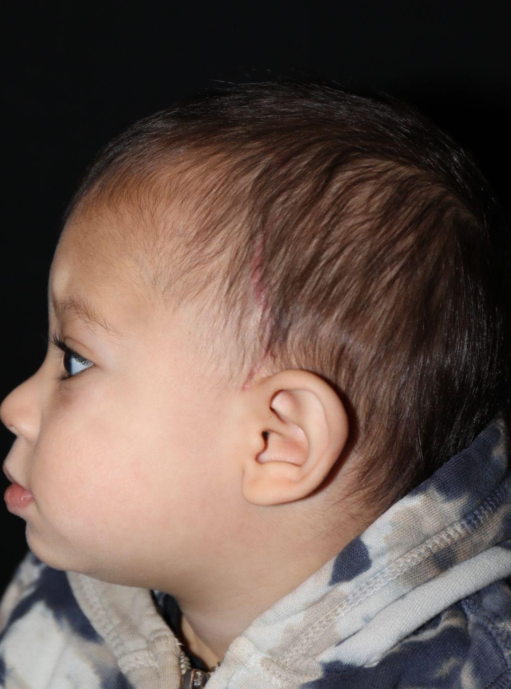 Left profile at Year 2 after treatment - Case 1004
