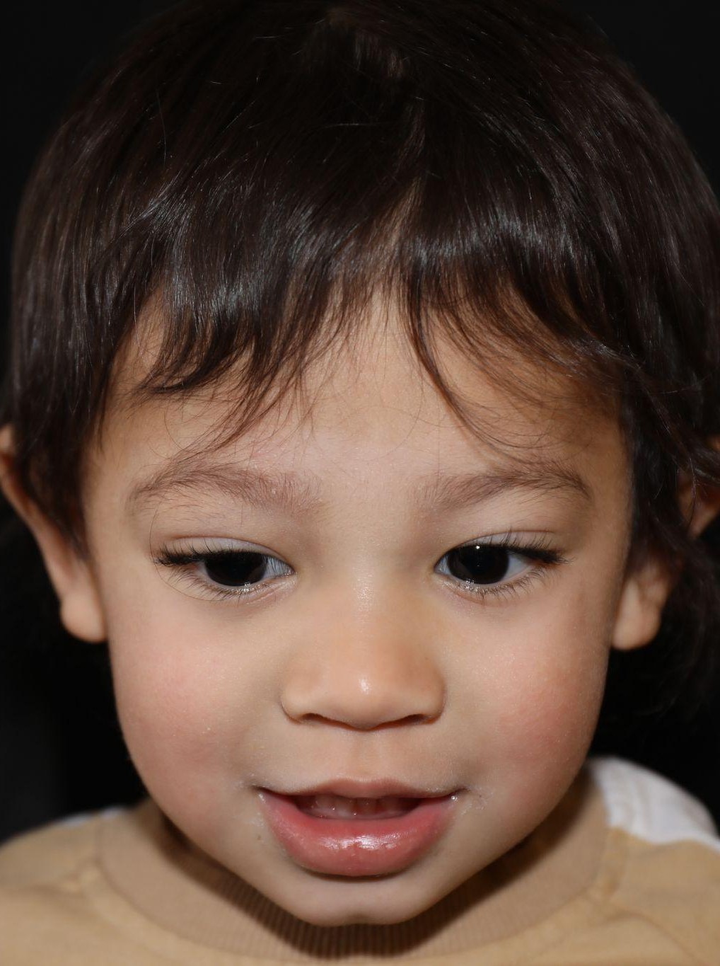 Front view at Year 3 after treatment - Case 1004