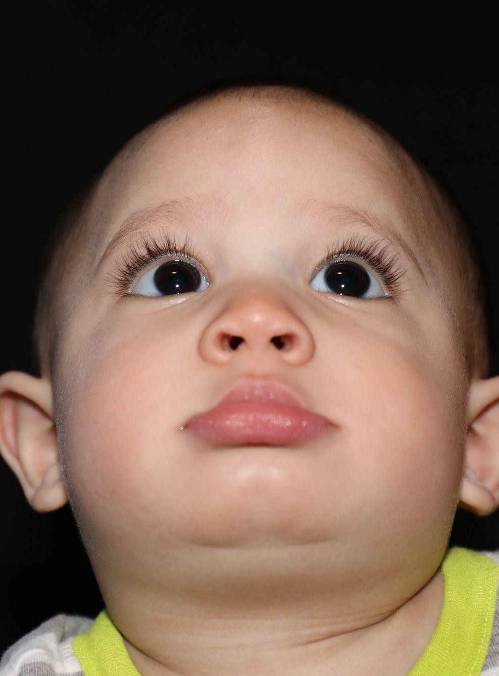 Chin before treatment - Case 1004