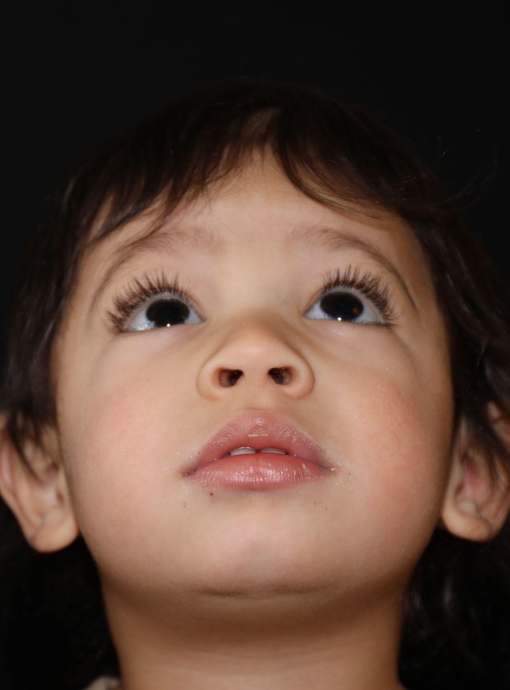 Chin at Year 3 after treatment - Case 1004