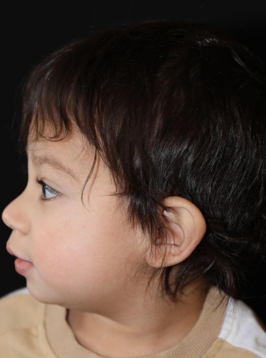 Left profile at Year 3 after treatment - Case 1004