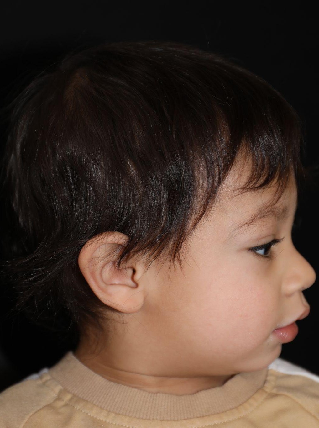 Right profile at Year 3 after treatment - Case 1004