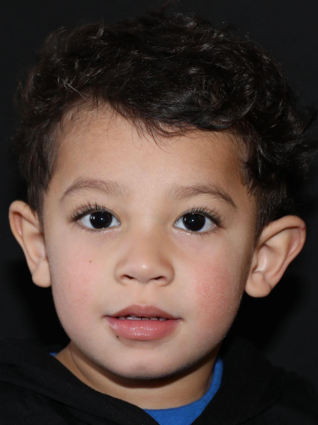 Front view at Year 4 after treatment - Case 1004