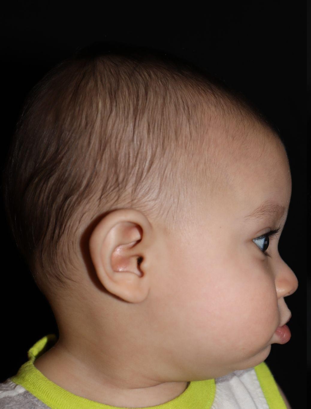 Right profile before treatment - Case 1004
