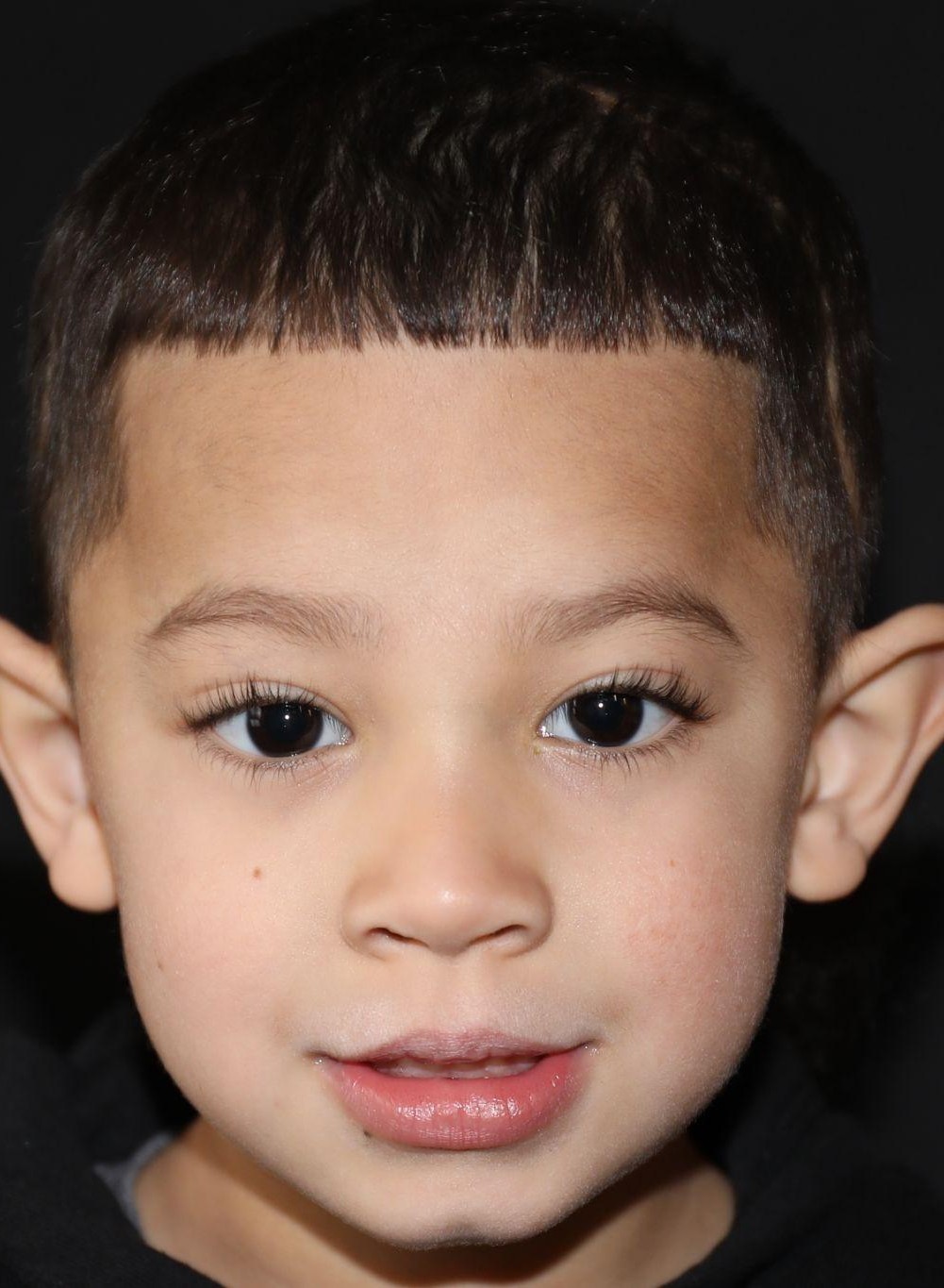 Front view at Year 5 after treatment - Case 1004