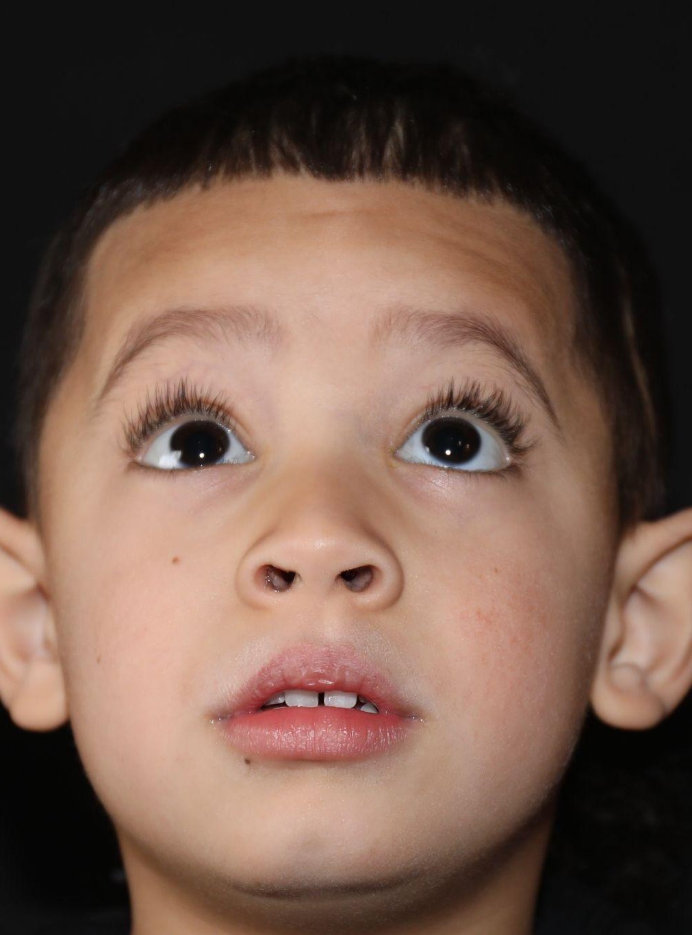 Chin at Year 5 after treatment - Case 1004