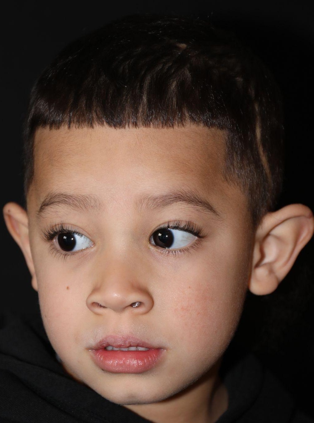 Left angle at Year 5 after treatment - Case 1004