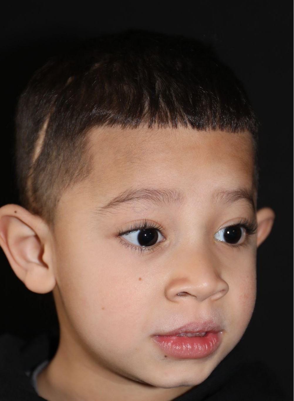 Right angle at Year 5 after treatment - Case 1004