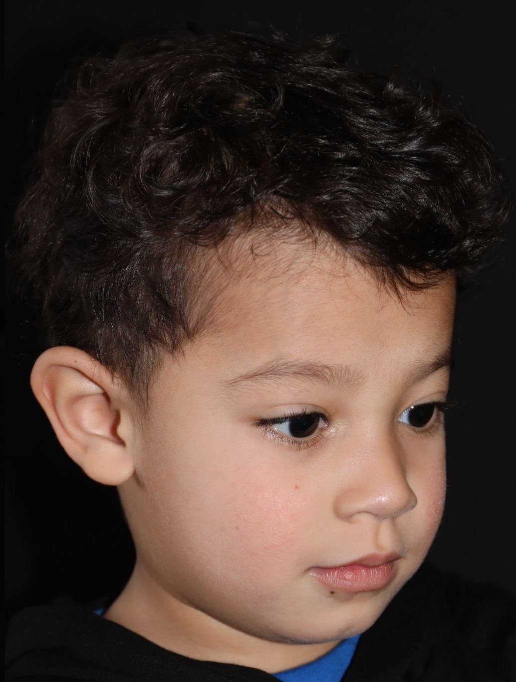 Right angle at Year 4 after treatment - Case 1004