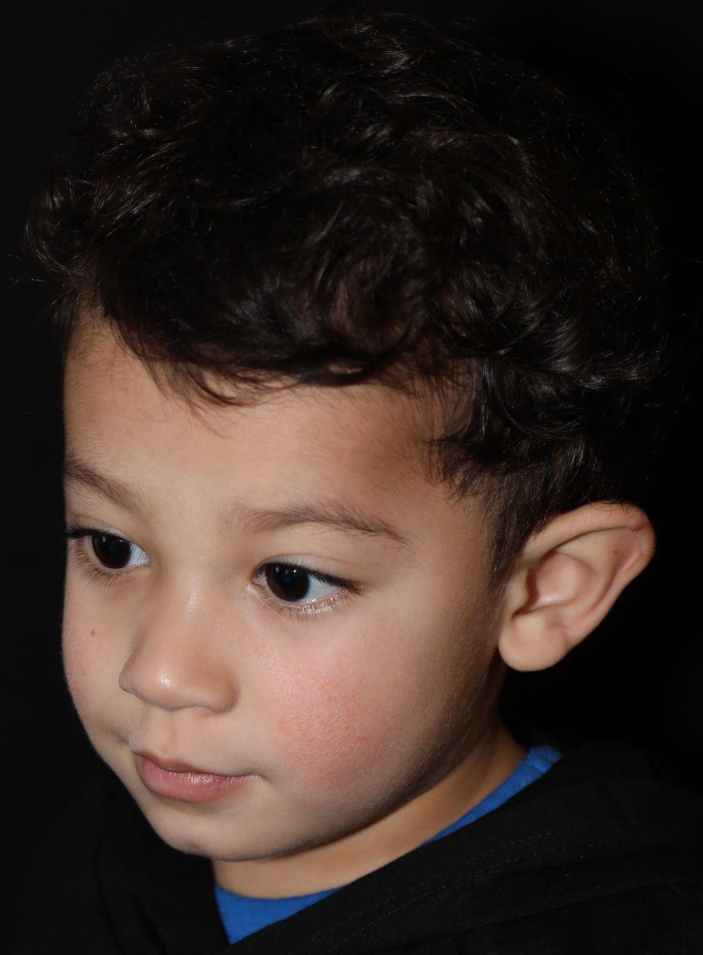 Right profile at Year 4 after treatment - Case 1004