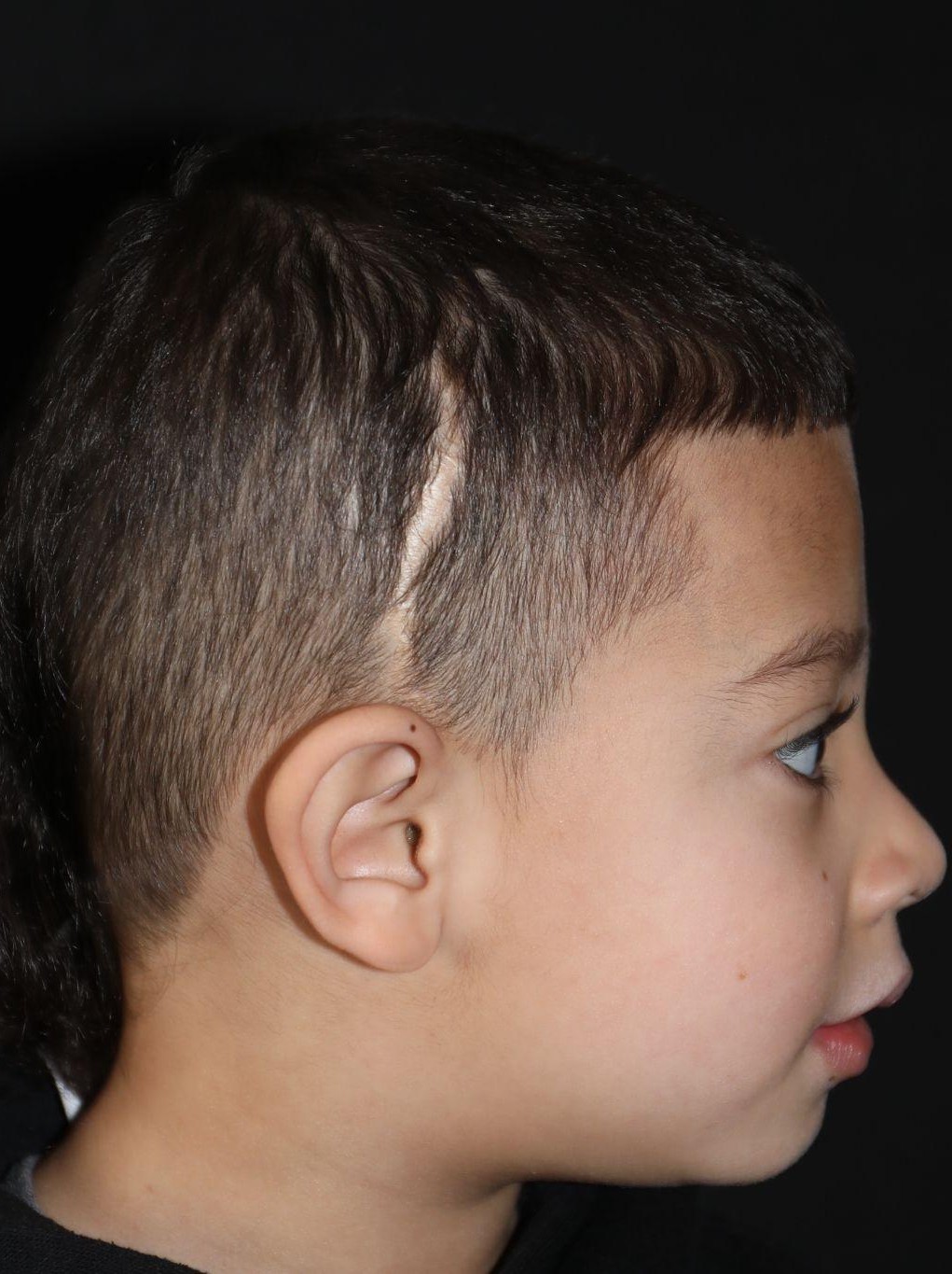 Right profile at Year 5 after treatment - Case 1004