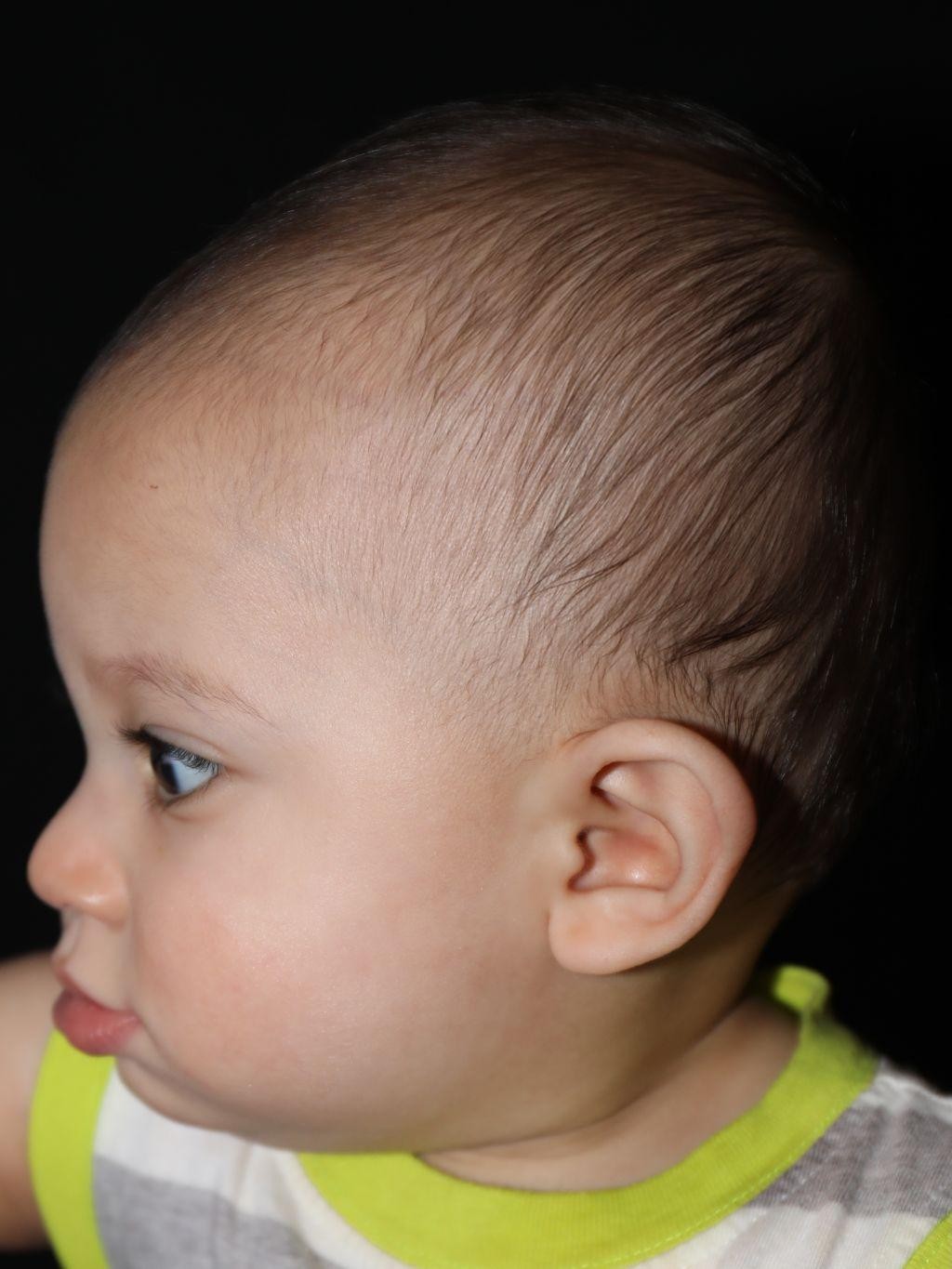 Left profile before treatment - Case 1004