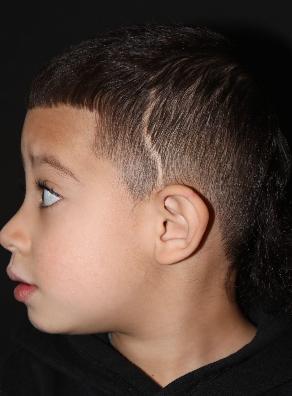 Left profile at Year 5 after treatment - Case 1004