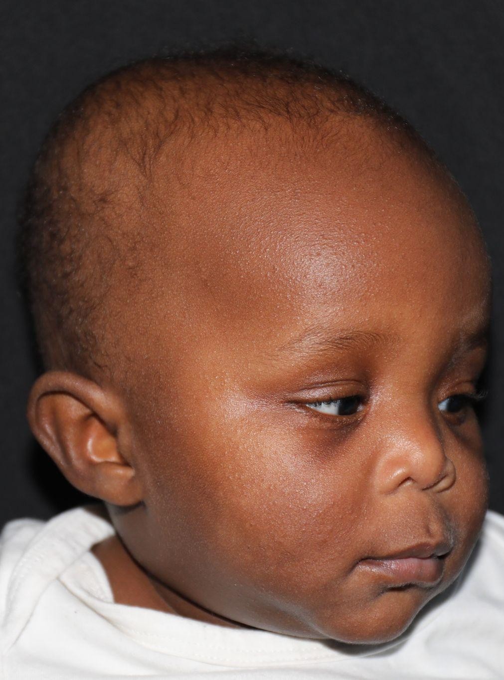 Right angle before treatment - Case 1005